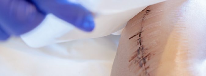 Suture Removal